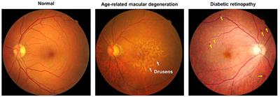 Age-Related Eye Diseases in Individuals With Mild Cognitive Impairment and Alzheimer's Disease
